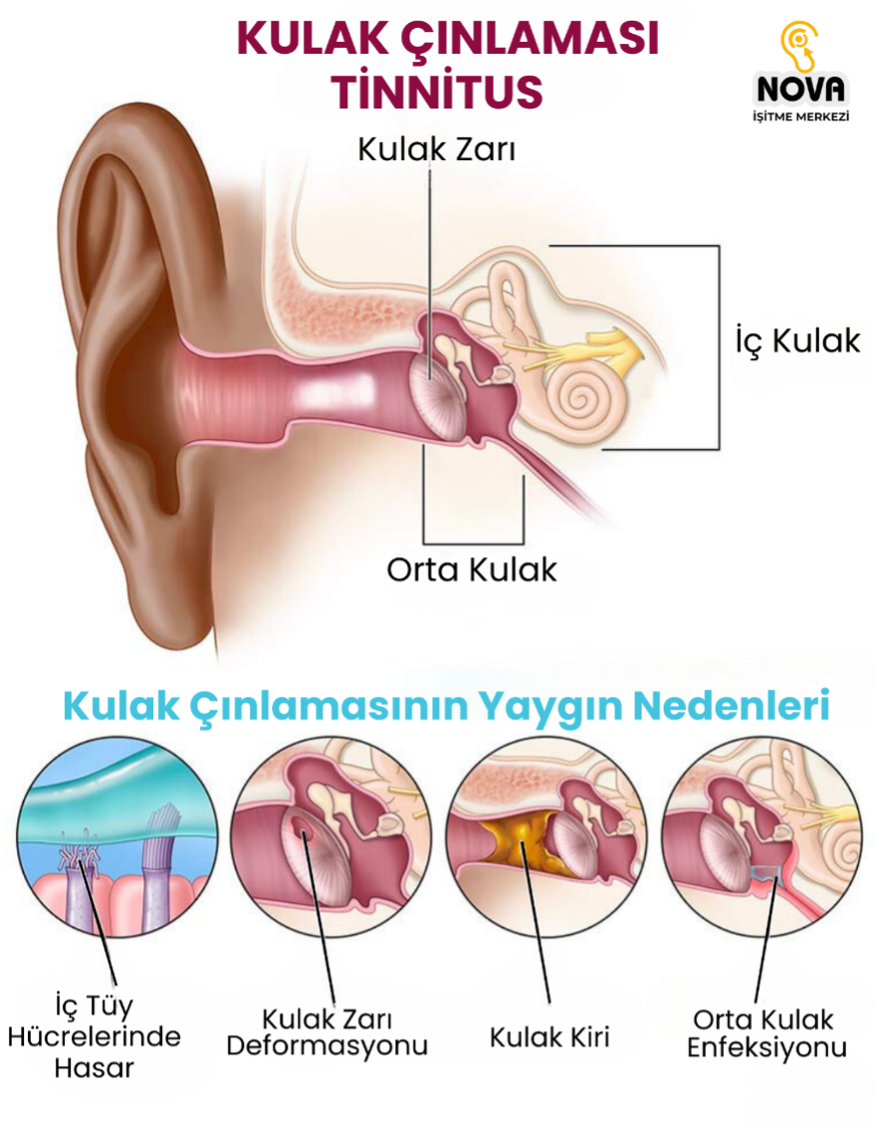 Kulak Çınlaması (Tinnitus) Nedir? Neden Olur? 21 kulak cinlamasi