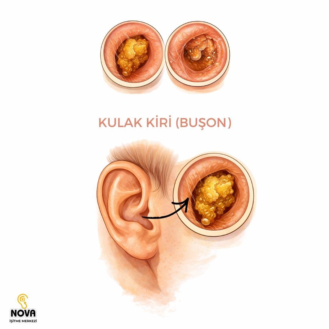 Kulak Temizleme Ücreti 5 kulak kiri